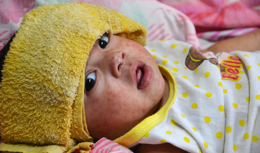 A baby with measles in a hospital in the Philippines capital city of Manila in 2014. 