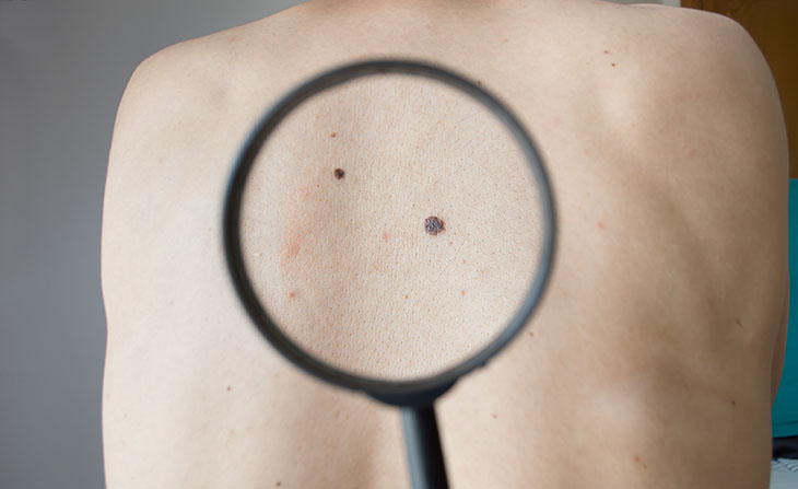 Suspicious mole on someone's back under a magnifying lens. 
