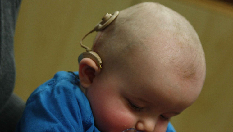 Infant with a cochlear implant. 