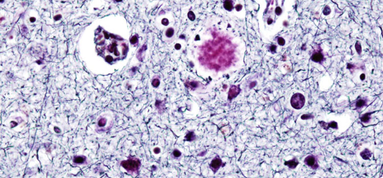 Image of Alzheimer's cells. 