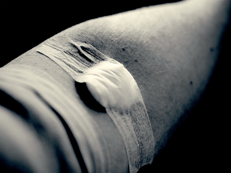 Elbow vein bandaged after phlebotomy (blood drawn). 