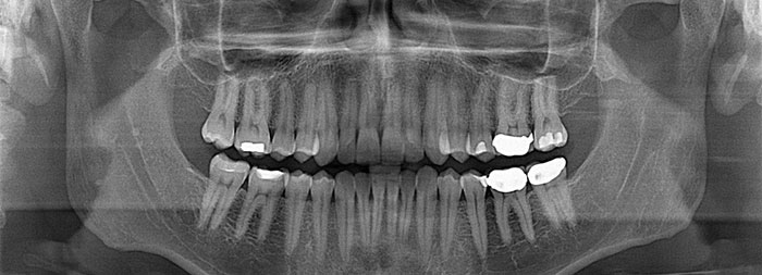 Dental X-Ray. 